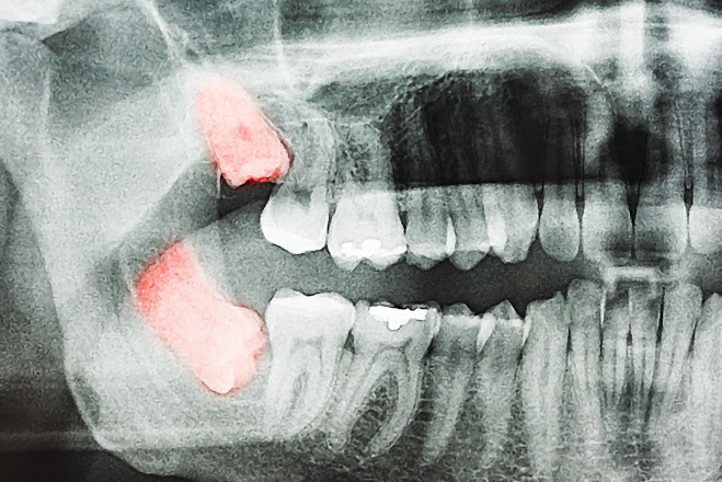 Dente Do Siso Segredos Que Voc Precisa Saber Md Odontologia