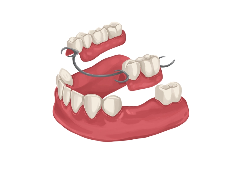 Metal partial dentures for lower arch