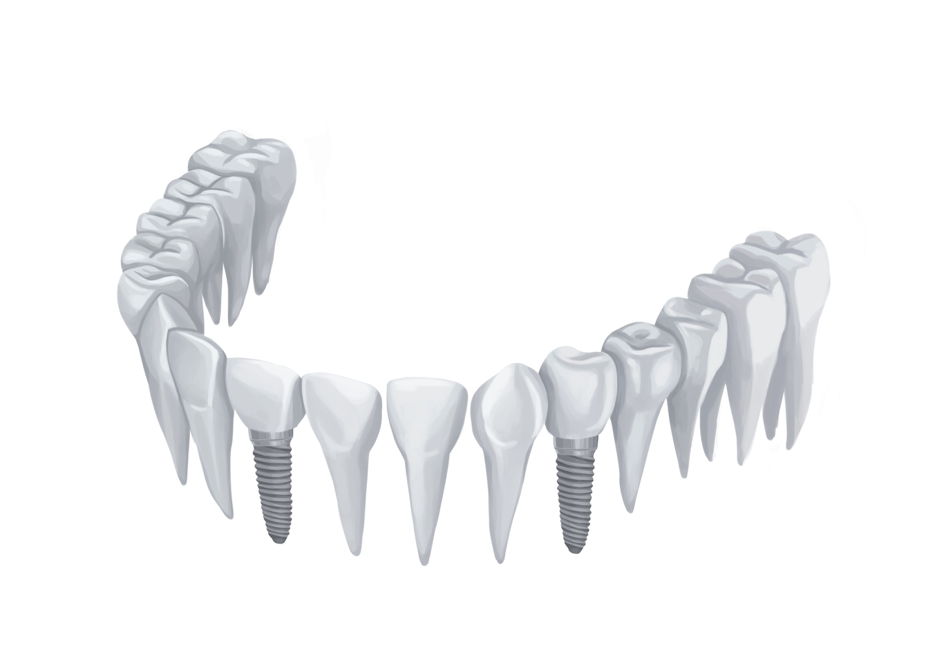 What Are Dental Implants   Dental Implants On Lower Arch Without Gums Technical Picture 50730166193 O 