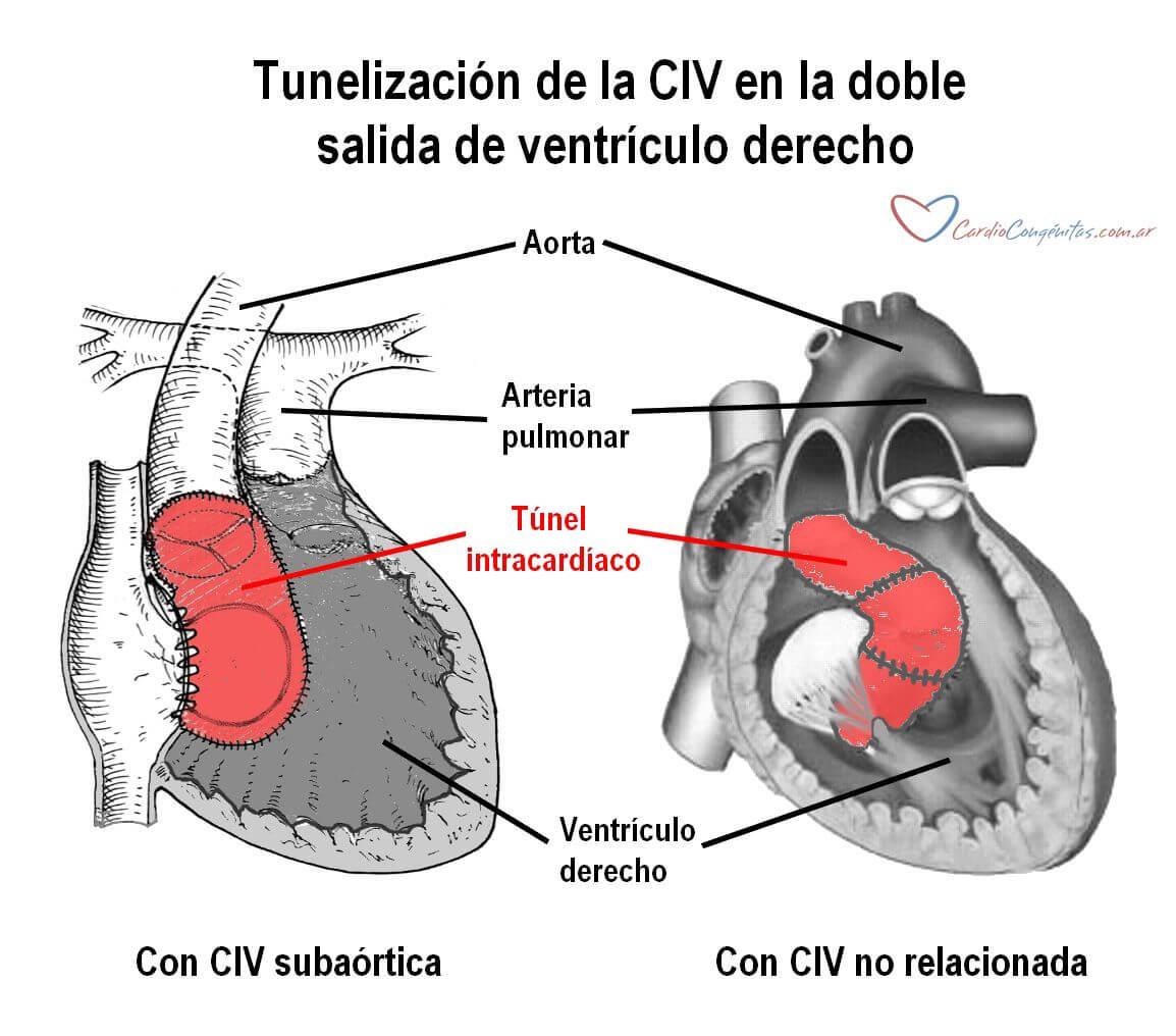 Tunelizacion-en-DSVD