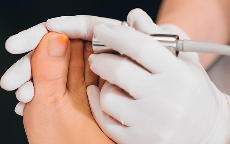 how laser toenail fungus therapy works
