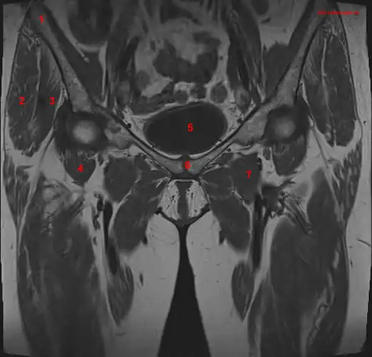 MRI of the Hip: Detailed Anatomy - W-Radiology