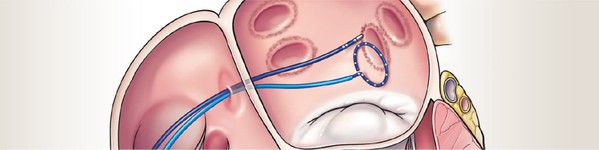 Ablatia de tahicardie | Centrele Ares | Inovatie in Cardiologie