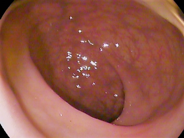 Normal rectum on colonoscopy