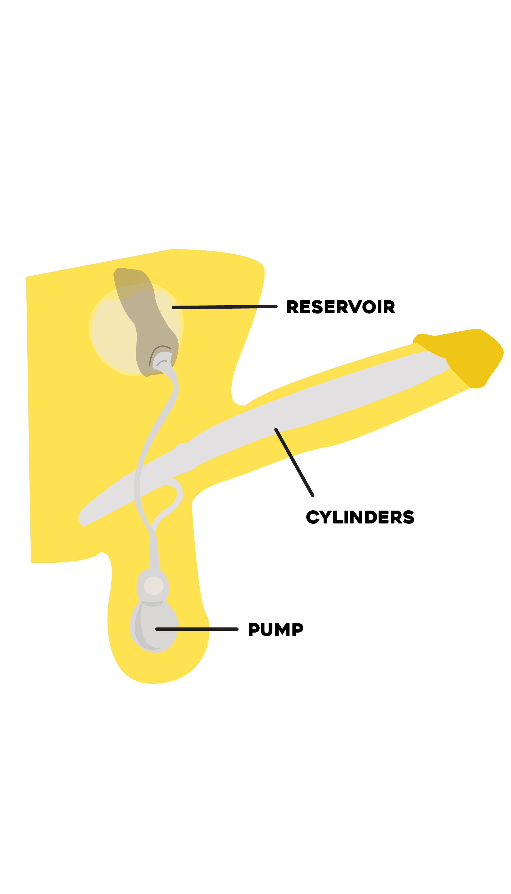 inflatable implant illustration