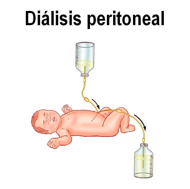 Dialisis-peritoneal