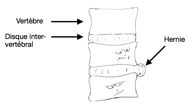 Schéma d'une hernie discale