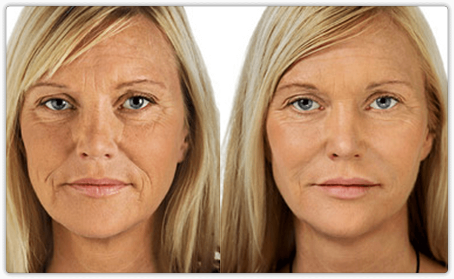 Botox and Skin Rejuvenation treatments in Toronto & Mississauga | Lip Doctor