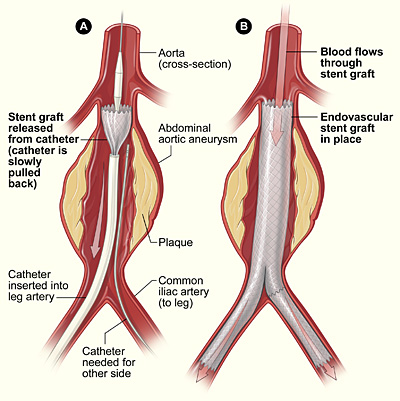 How to do endovascular aneurysm repair