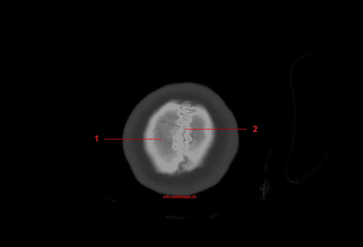 Skull CT anatomy