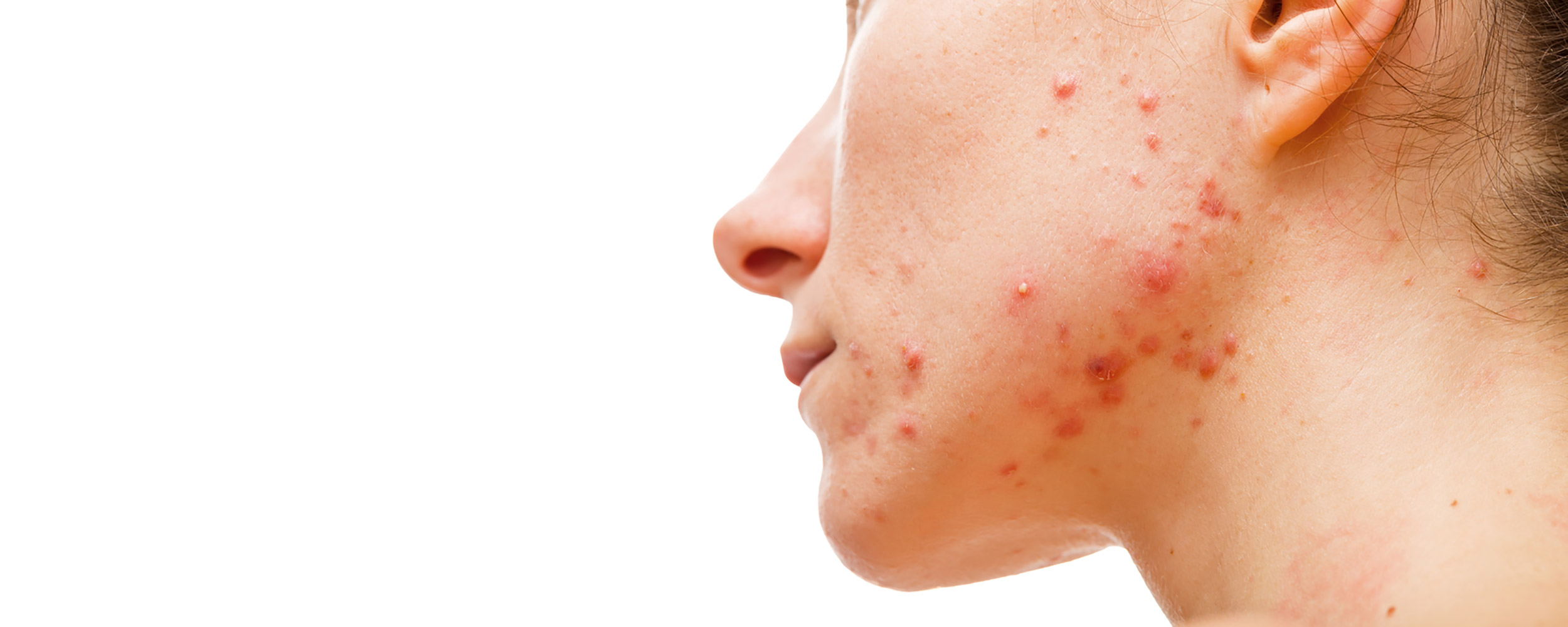 Acne: Overview, symptoms and treatment