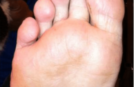 Athletes Foot Solution Imperial Feet