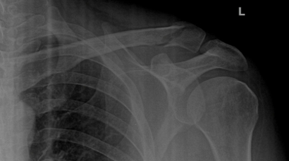 Distal_clavicle_fracture_repair_with_bone_tunnels_and_suture.jpg
