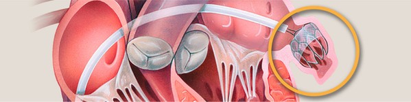 Procedura Watchman pentru Fibrilatie Atriala | Centrele Ares | Inovatie in Cardiologie