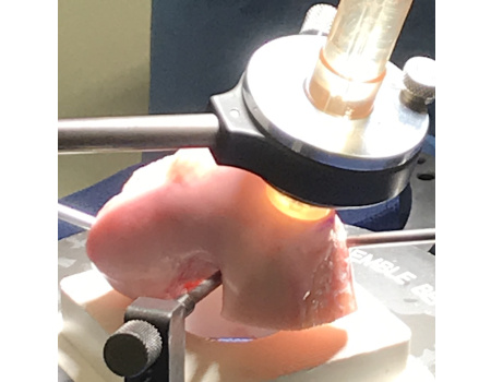 Allograft_plug_harvesting.jpg