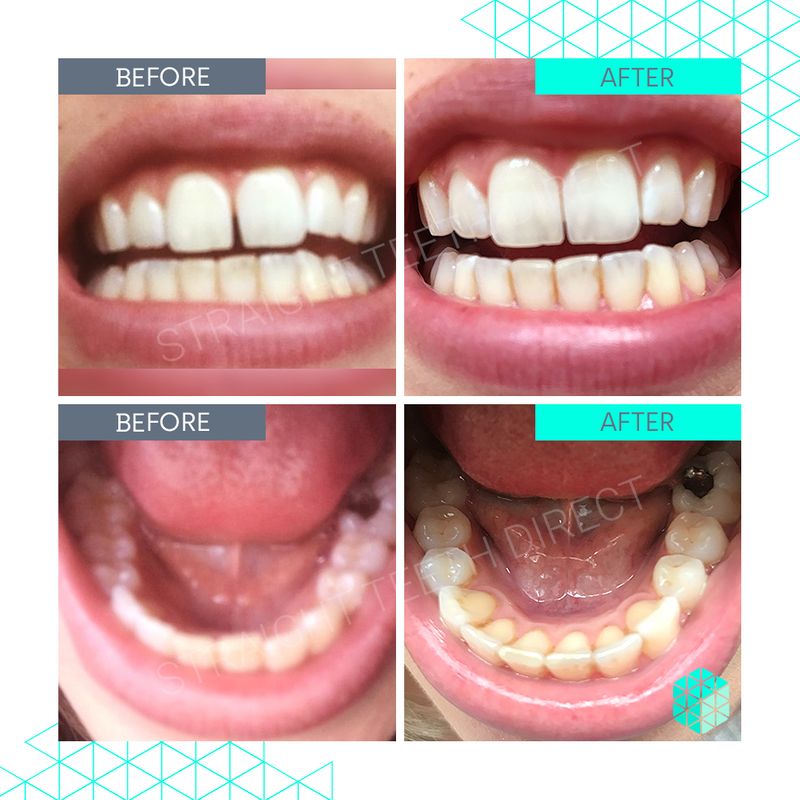 straight-teeth-direct-pricing-aligner-cost-made-simple