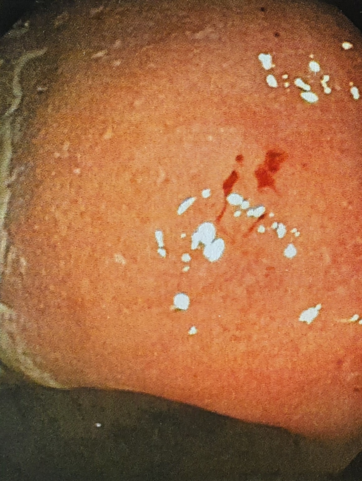 Another colonoscopic view of the proctitis.