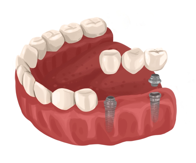 Implant dental bridge