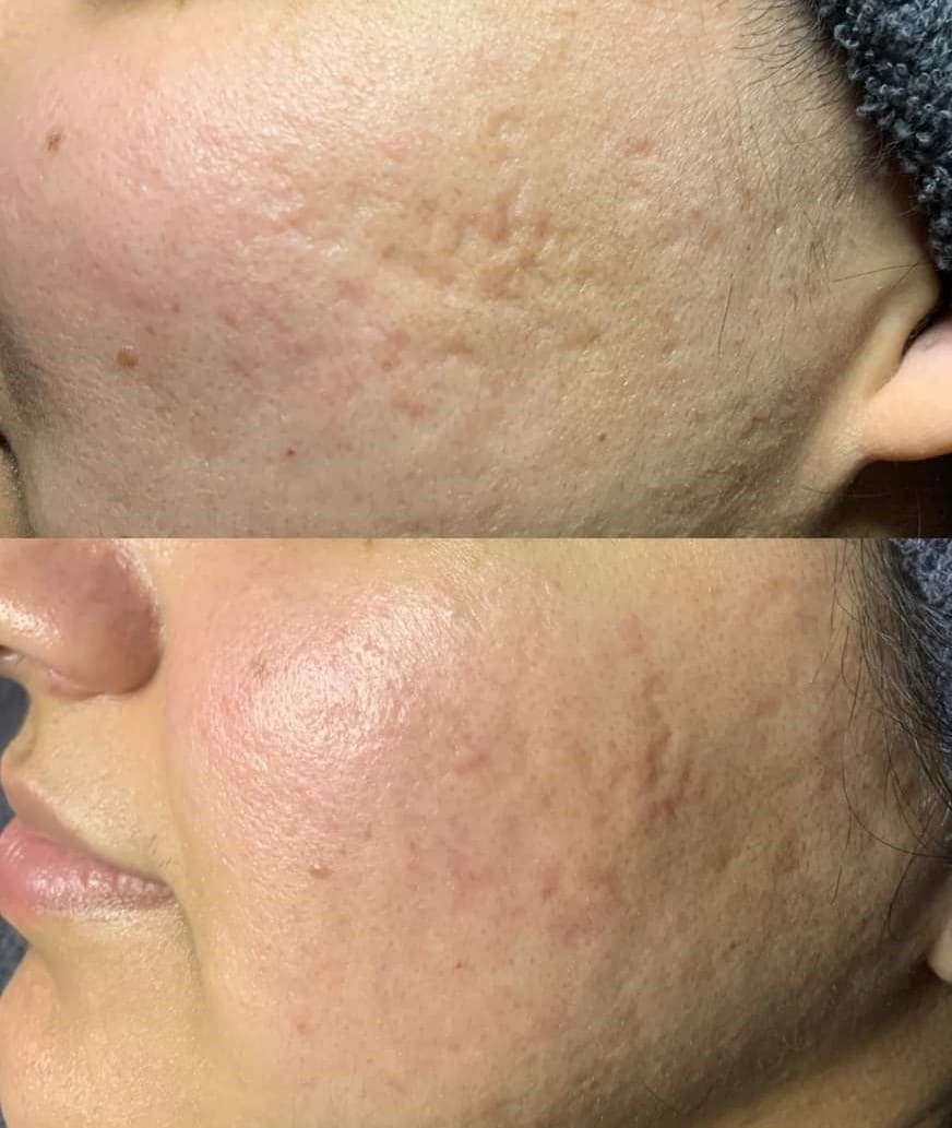 Microneedling Before & After Treatment at Essence of Beauty Ottawa