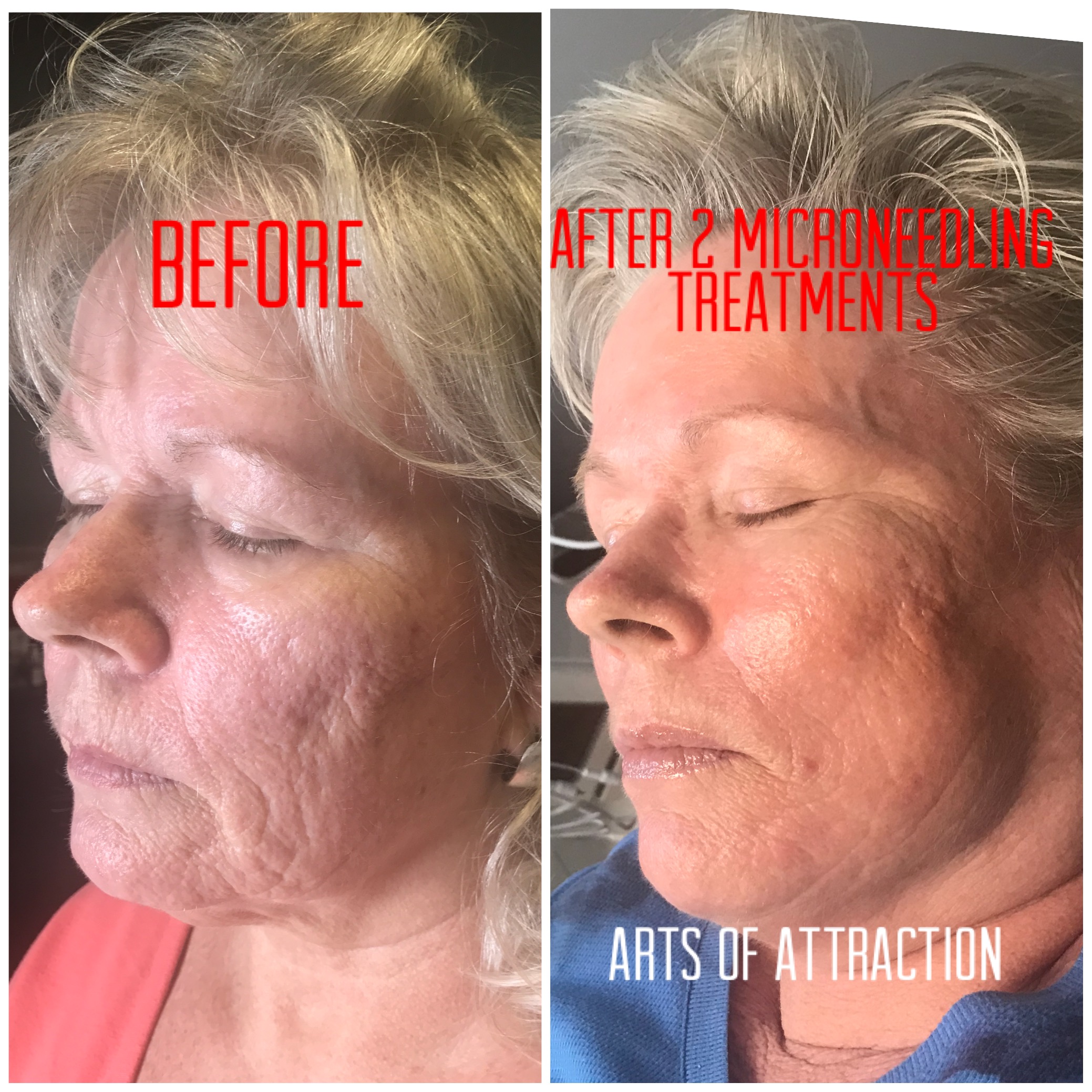 Microneedling - Better than Botox and Fillers