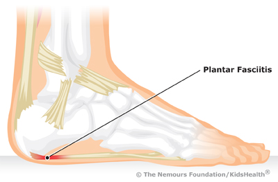 "Plantar