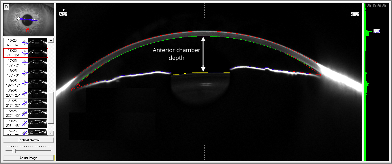 Optical And Ultrasound Biometry - Innovative Eye Care