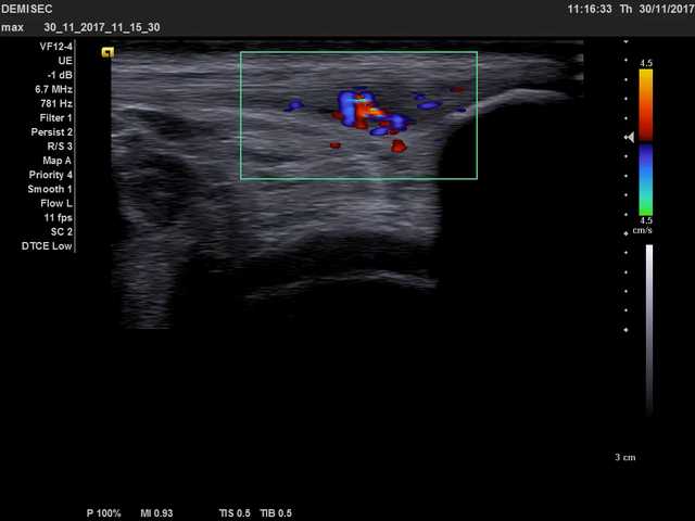 Billede af inflammeret knæskalssene med positivt Dopplersignal (indikerer Inflammation og karinvækst)