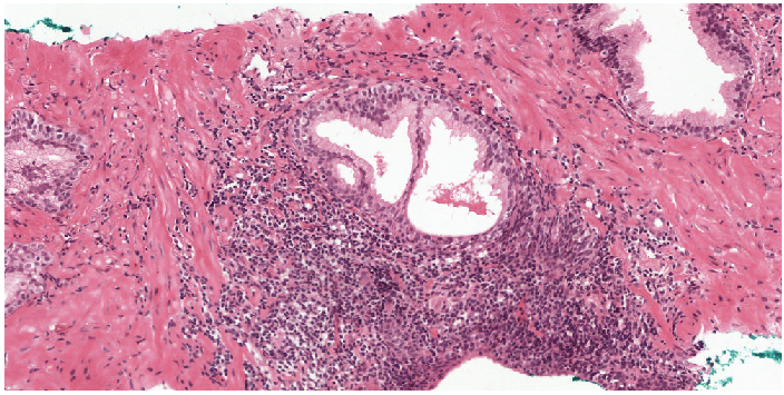 Benign area from a prostate biopsy