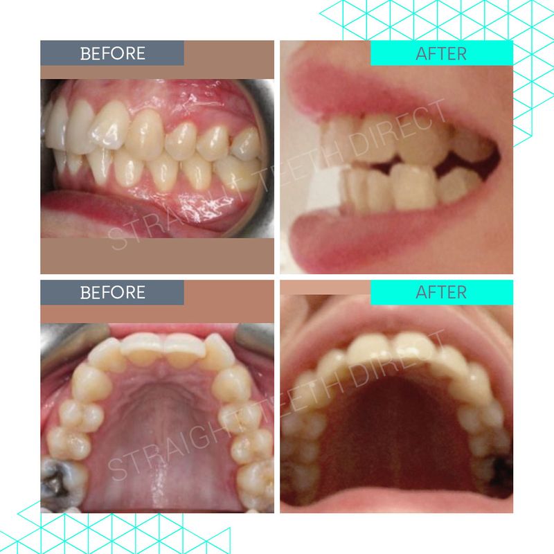 Maintainer Plan Prevent teeth from moving back