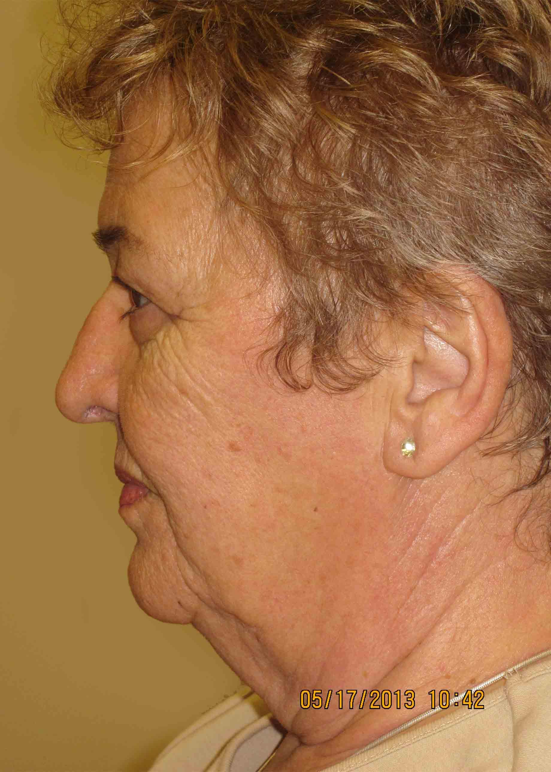 12730-2-pre-profile-facelift.JPG