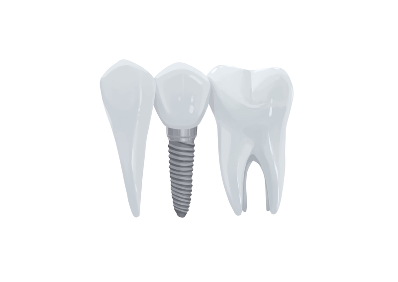 Dental implant between teeth