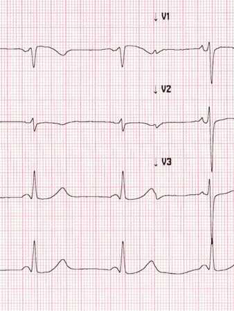 Bradicardia – cauze, simptome, tratament