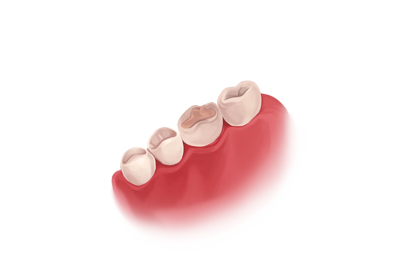 Cavity filling types and procedure I Authority Dental