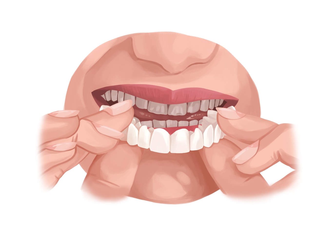 Dental veneers types (porcelain, composite, snapon) and process