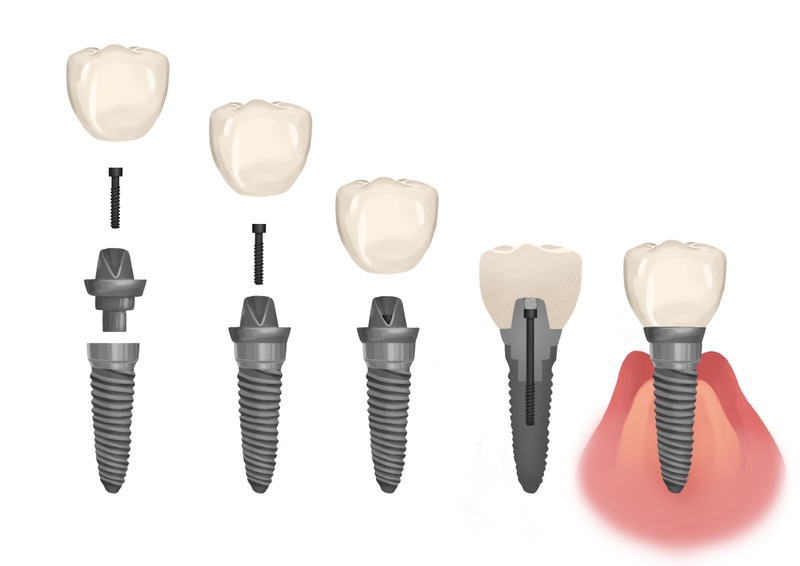 Dental implant in parts
