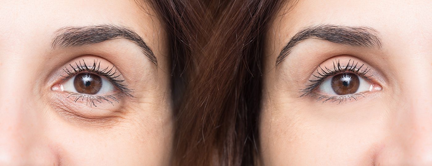 under eye wrinkle treatment before after