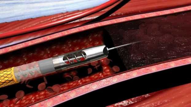 Trombectomie mecanica, prin sisteme Rotarex S si Aspirex S