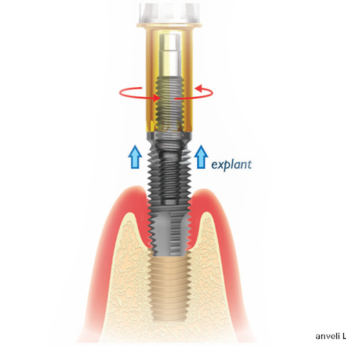 Procédure de retrait et d'extraction d'un implant dentaire