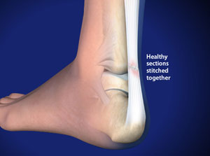 "Plantar