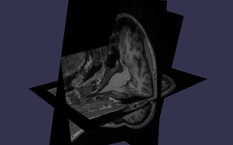 MRI