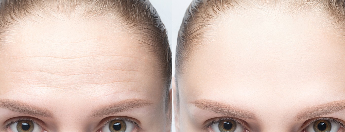 botox injection in mississauga before after