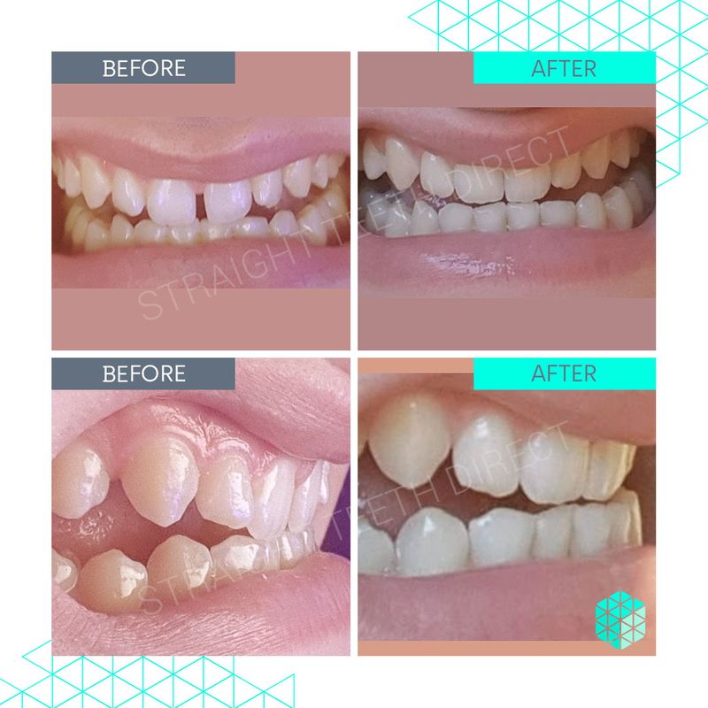 Straight Teeth Direct Pricing Aligner cost made simple