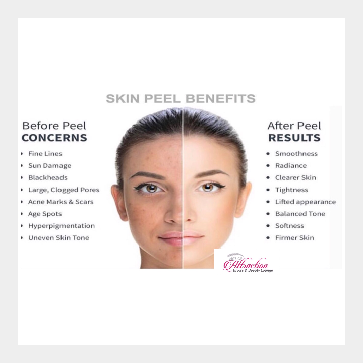 What is a Chemical Peel?