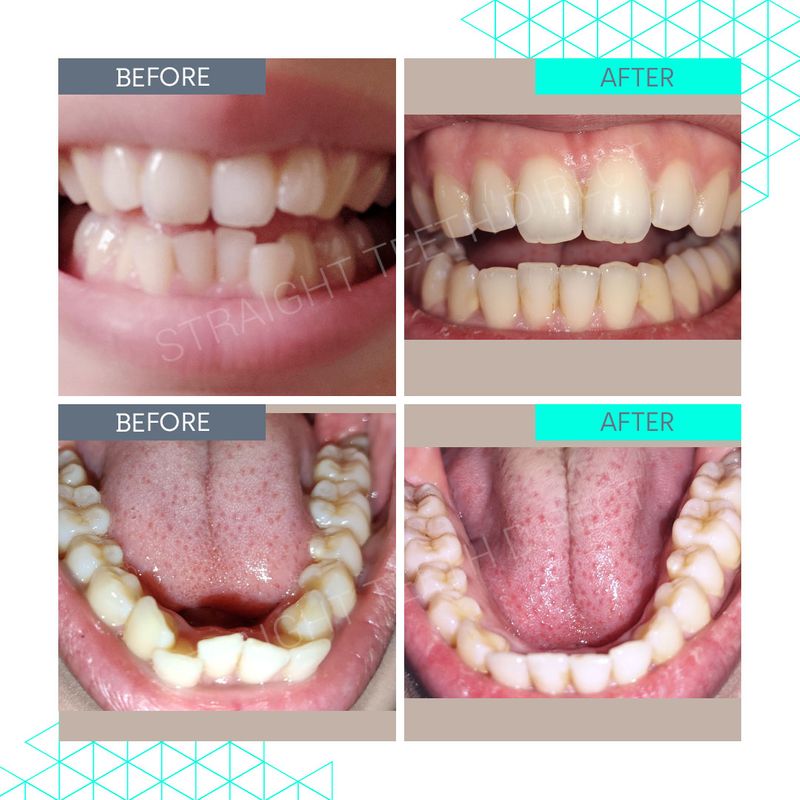 Straight Teeth Direct Pricing Aligner cost made simple