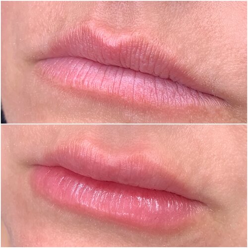Arts of Attraction Hyaluronic Lip Infusion