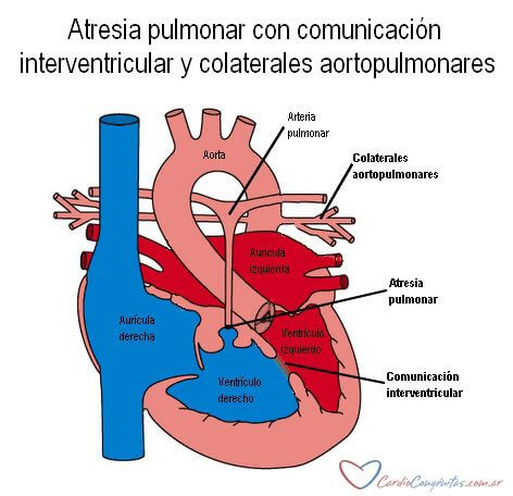 Atresia Pulmonar