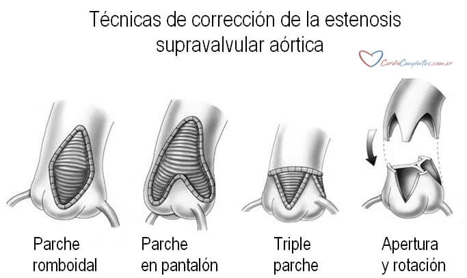 Tecnicas-qcas-est-supravalv-ao