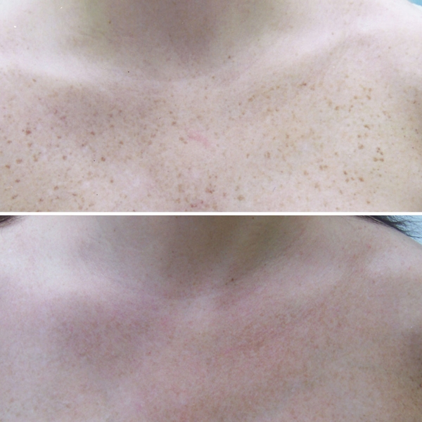 before-after-skin-treatments-4