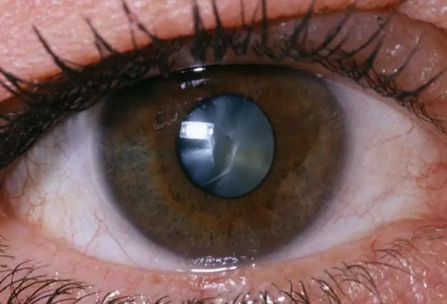 A cataract