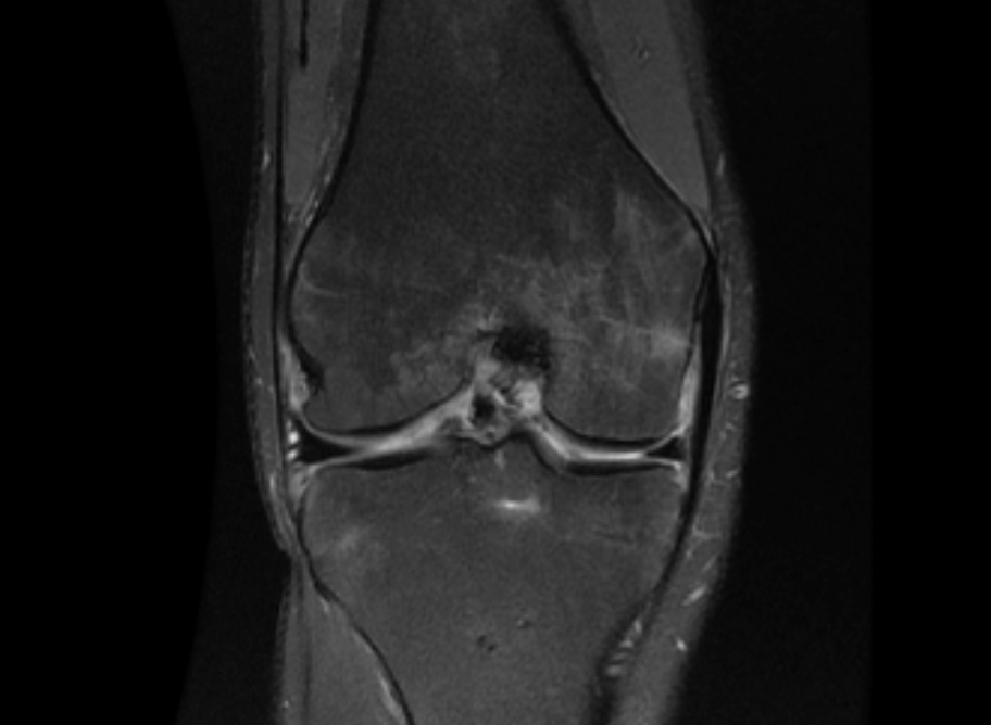 post-op-mri-anatomic-healed-avulsion.png